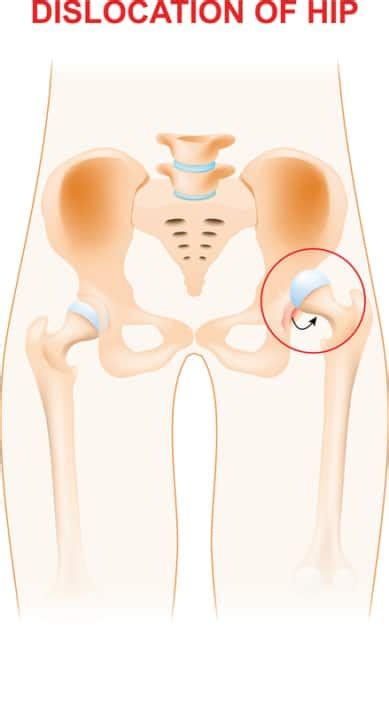 Dislocation of hip - Colorado Center of Orthopaedic Excellence