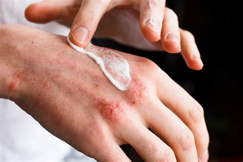 5 Tips to Prevent Eczema Flare-Ups | Garden City, NY & Syosset, NY ...