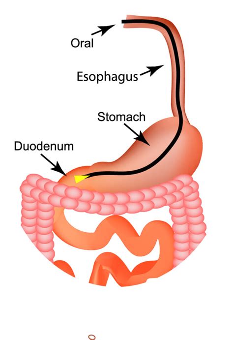 Upper Endoscopy/EGD (Esophagogastroduodenoscopy) | USDH