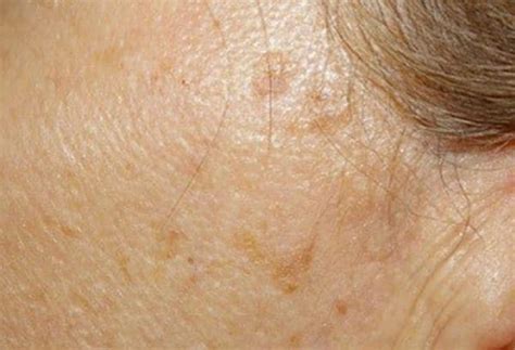 does compound w work on seborrheic keratosis - Philomena Mcclung