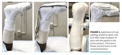 The Custom Total Contact Cast to Offload Foot Ulcers in the Presence of Biomechanical ...