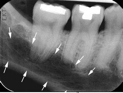 Submandibular Fossa Radiograph