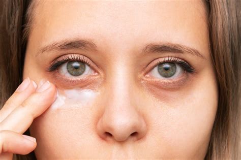 Sunken Eyes (Enophthalmos) Causes, Treatment, Remedies & FAQ