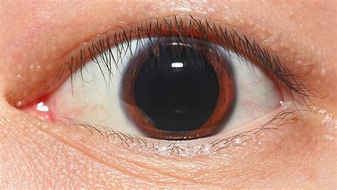 Mydriasis - Wikipedia