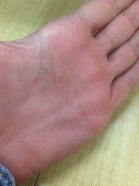 Help!!!!! Lump in palm, possible pulley injury? or Dupuytren's?