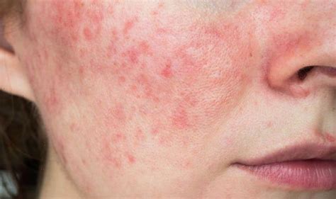 Lupus symptoms: The 'butterfly-shaped' rash on your face you should never ignore - WSTale.com