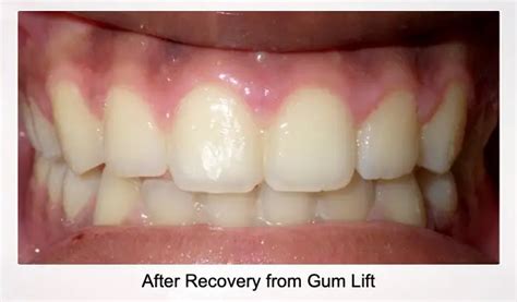 Gum Lift in NY, NJ, CT: Complete Guide