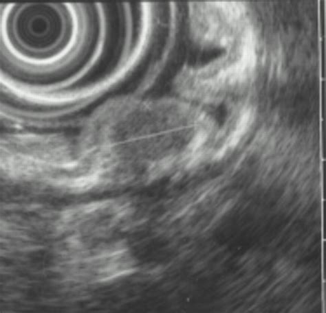 How to evaluate a gastric submucosal tumour in a patient with haematemesis? | Gut