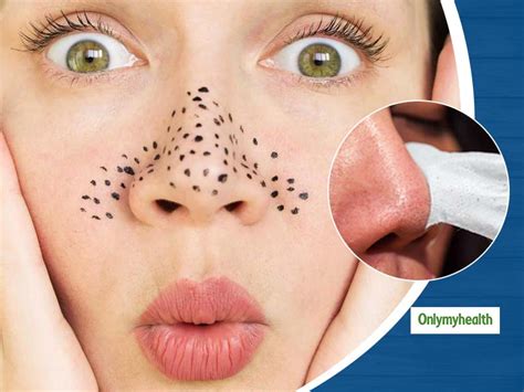 Blackheads On Face? Here Are The Causes, Symptoms And Treatment | OnlyMyHealth