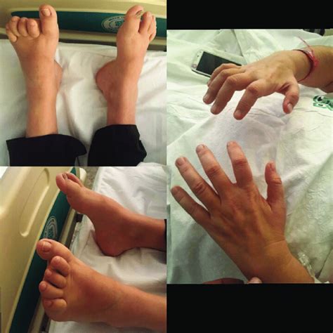 The appearance of the patient's hands and feet | Download Scientific ...