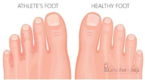 Athlete's Foot: Symptoms, Types, Causes, Treatment,, 56% OFF