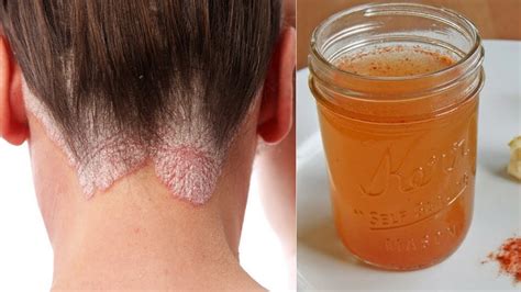 Threat Dandruff Naturally With These 3 Amazingly Effective Remedies ...