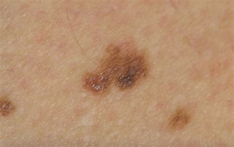 Managing non-melanoma skin cancer in primary care: A focus on topical treatments - BPJ 57 ...