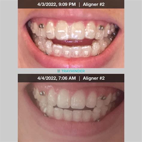 Invisalign open bite struggle. Bite is so much worse with trays in 😅 : r/Invisalign