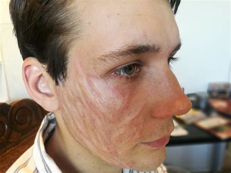Burn Scar | MAD | Makeup Arts & Designs