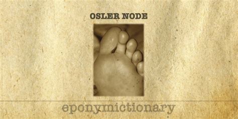 Osler node • LITFL • Medical Eponym Library