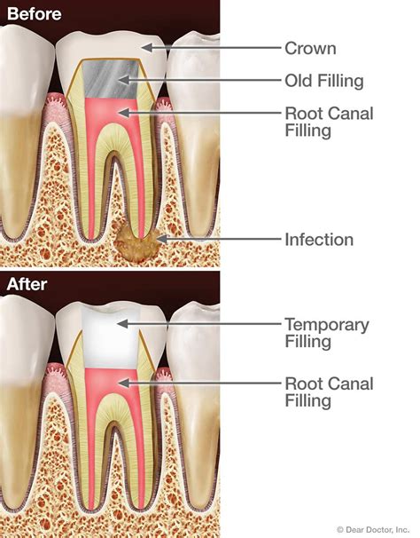 Root Canal Retreatment | The Office of Dr. John Sudick | Whittier California