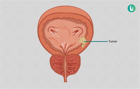 Bladder Cancer: symptoms, causes, treatment, medicine, prevention, diagnosis