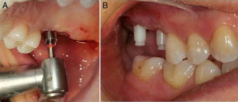 Figure 2. Flapless surgical technique, atraumatic surgical procedure for zirconium implants ...