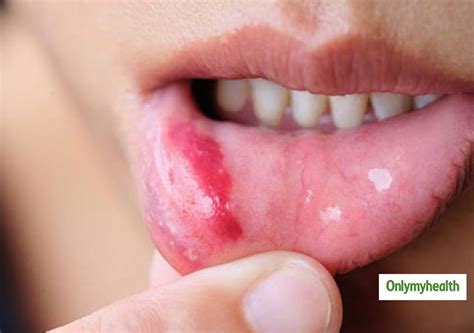 Itchy gums: Causes, Treatment And Prevention From An Expert | OnlyMyHealth