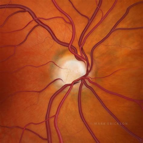 Optic nerve cupping in glaucoma, 0.9 c/d ratio, glaucoma illustration