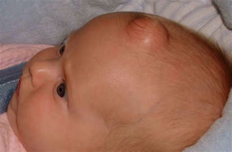 Epidermoid Cysts Causes, Symptoms, Diagnosis and Treatment - Natural Health News