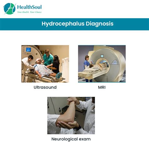 Hydrocephalus: Symptoms, Diagnosis and Treatment – Healthsoul