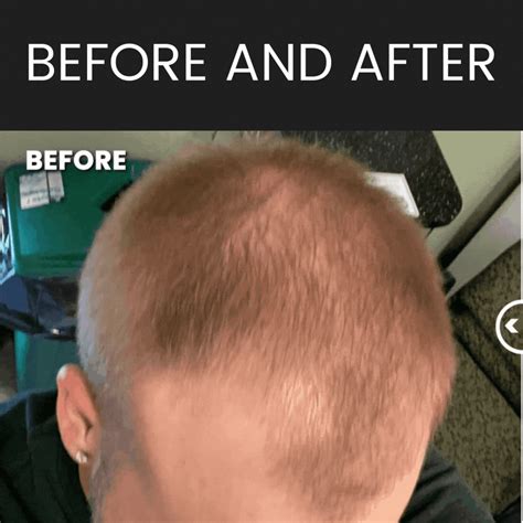 The Magic of Minoxidil! - Hair Restoration Laboratories