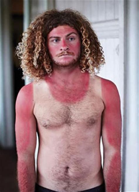 23 Funny Sunburns That Make Us Glad We Spend All Day On The Internet