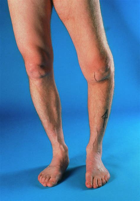 Severe Osteoarthritis In The Left Knee Photograph by Medical Photo Nhs Lothian/science Photo ...