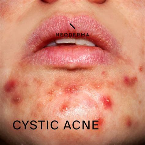 Cystic Acne – NEODERMA