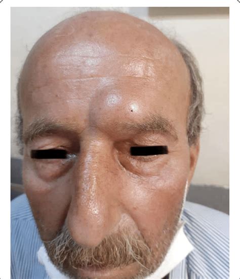 The patient presenting with a left-sided frontal bossing | Download Scientific Diagram