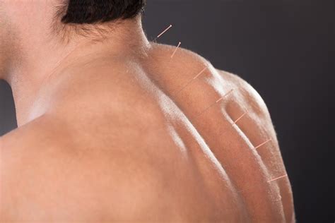 Treating Arthritis With Acupuncture: Jersey Integrative Health and ...