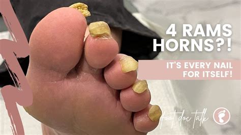 4 Rams horn nails on one foot?! 🐏 - YouTube