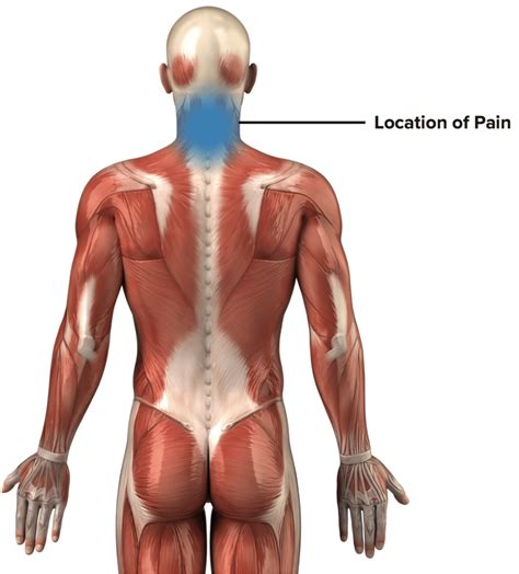 Neck Strain Climbing Rehab Protocol