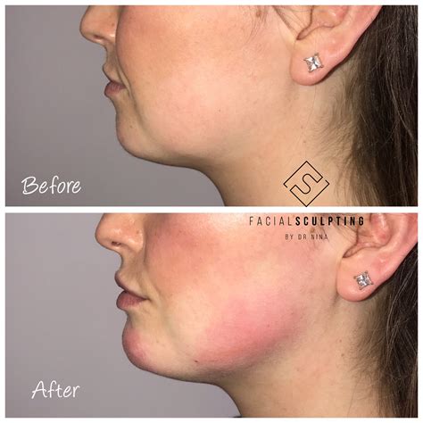 Jawline fillers - Facial Sculpting - Jawline Fillers Specialist in London