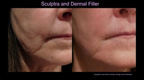 Instant Impressive Jowl Treatment – Charmed Medispa