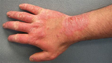 Hand Rashes: Causes, Tips, Prevention, & Treatment