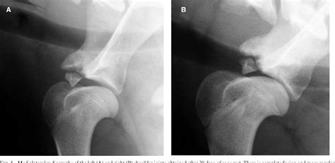 Imaging diagnosis-bilateral abnormal ossification of the supraglenoid tubercle and cranial ...