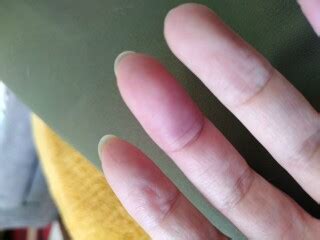 Have I got a blood clot in my finger? | Mumsnet