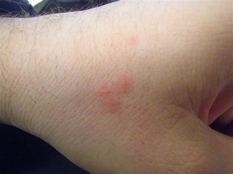 Bed Bug Bites Effects | Moreoo
