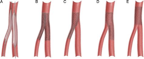 SUPERA Stenting in the Common Femoral Artery: Early Experience and Practical Considerations ...