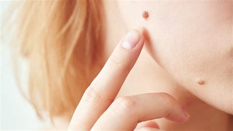 Benign Skin Growths: Causes, Treatment & Prevention - Toronto Dermatology Centre