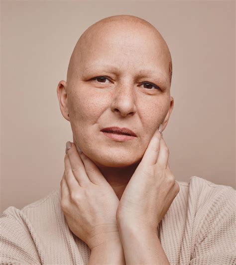 Alopecia Totalis – Causes, Symptoms, Treatment, And Risks