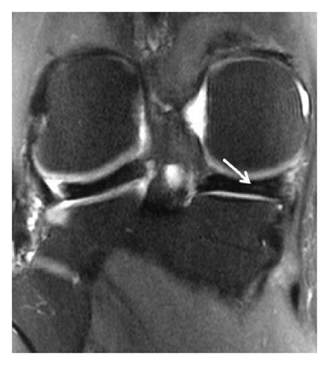 Displaced bucket-handle tear of the medial meniscus. (a) Coronal T2 FSE... | Download Scientific ...