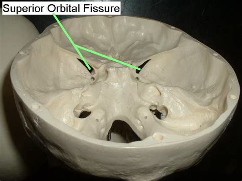 Superior orbital fissure : one part of sphenoid bone | Health science ...