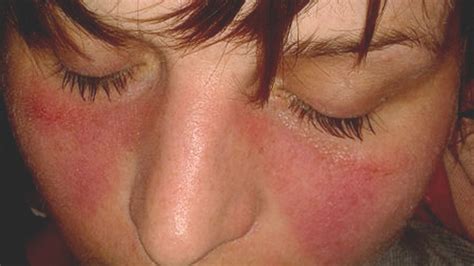 Cutaneous Lupus Face