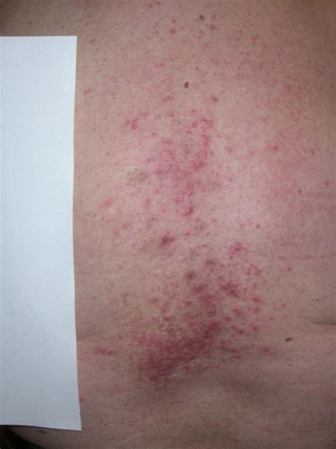 Herpes Zoster Syn Shingles - vrogue.co