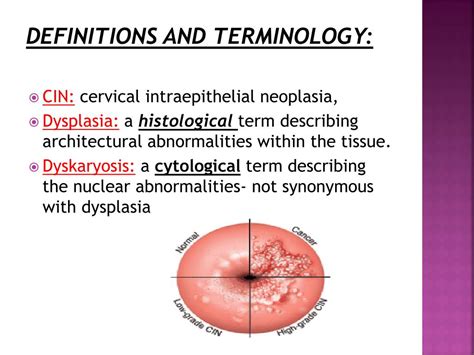 PPT - Premalignant conditions of the cervix PowerPoint Presentation ...