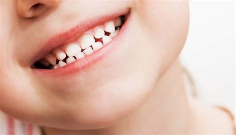 Teeth Whitening for Kids – Is It Safe? | SA West